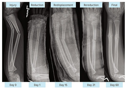 Fig A:  Despite conventional wisdom, these images demonstrate that rereduction of both-bone forearm fractures produces satisfactory outcomes, with apex angulations less than 5 degrees. Rereduction also costs less than surgery. 
